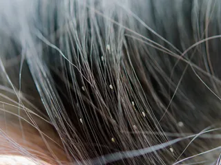 Can Dogs Get Lice From Humans? Vet-Approved Facts & FAQ