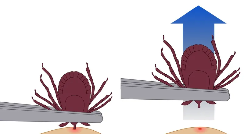 Removal of a tick using tweezers