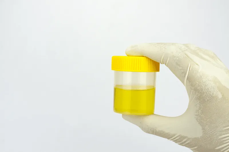 Urine sample bottle