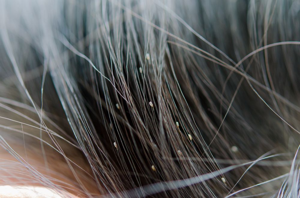 Lice-eggs-on-the-childs-head