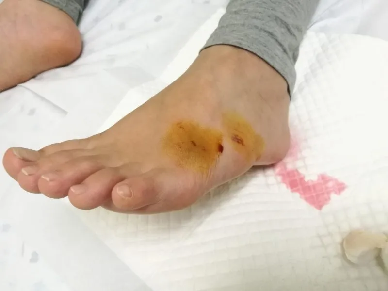 First aid to girl kid bite by dog on foot leg