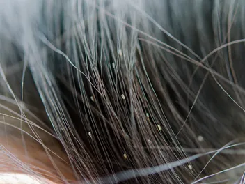Can Dogs Get Lice From Humans? Vet-Approved Facts & FAQ